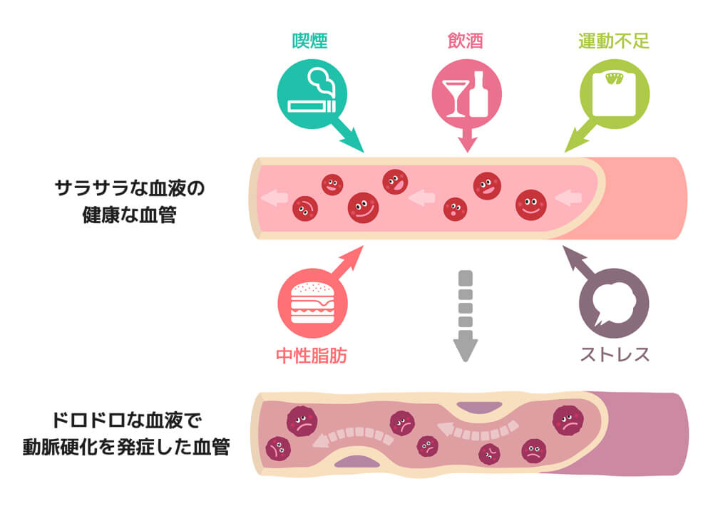 イラストで動脈硬化の説明をしている図